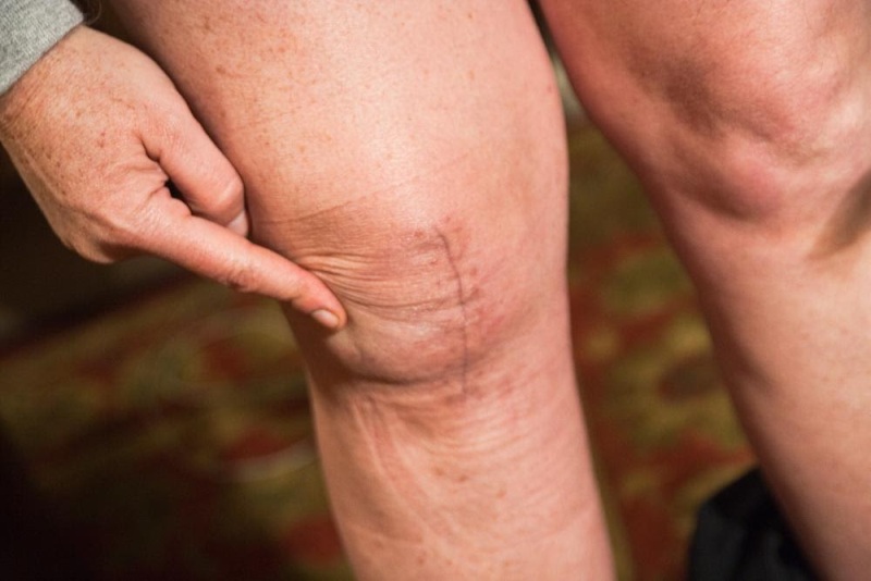 5 Tested Tips to Take Care of Your New Knee Joint