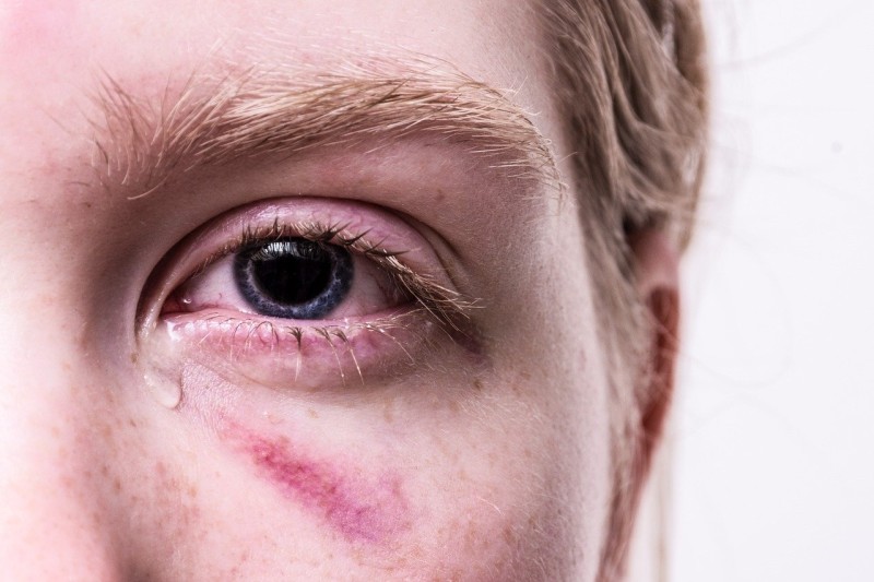 4 Eye Problems Common in COVID-19 Patients